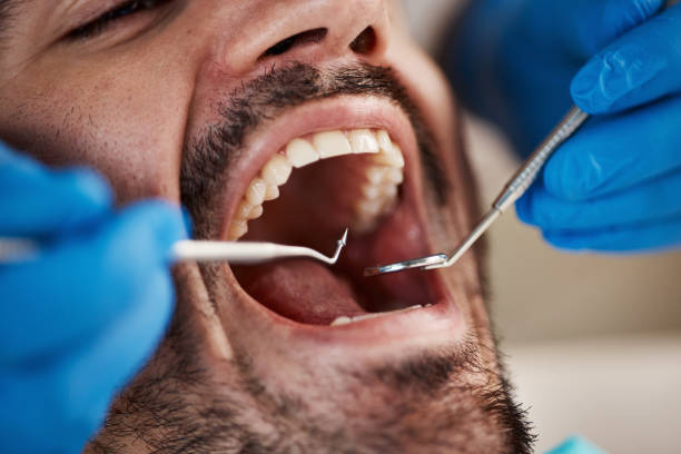 Best Emergency Wisdom Tooth Extraction in Elkin, NC
